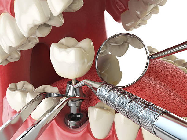 Best Emergency Treatment for Toothache in Thompson Falls, MT